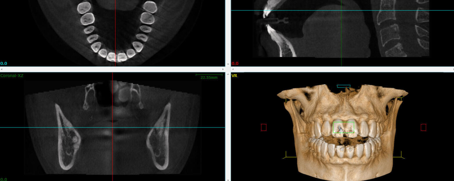Tomografía 3D con CBCT (Cone Beam Computed Tomography)