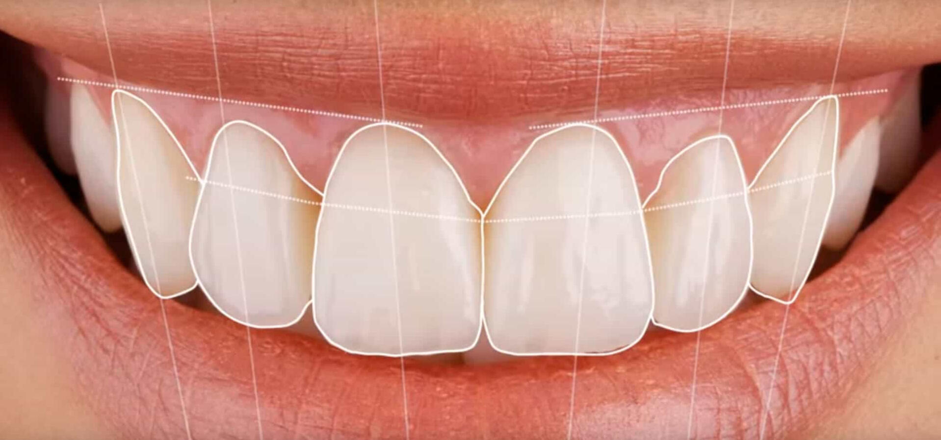 Impresión 3D Interna de Guías Quirúrgicas y Restauraciones